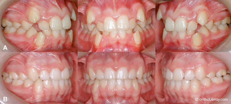 Quand faut-il avoir recours à des extractions dentaires ? - CISCO -  Formation en orthodontie en France, formation orthodontie à Paris,  formation d'orthodontiste