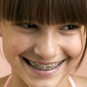 contention orthodontique