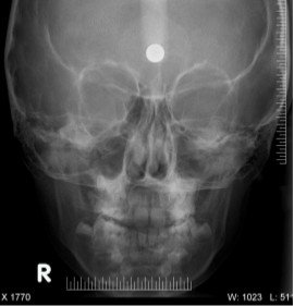 Téléradiographie de face 03
