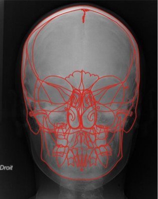 Téléradiographie de face 04
