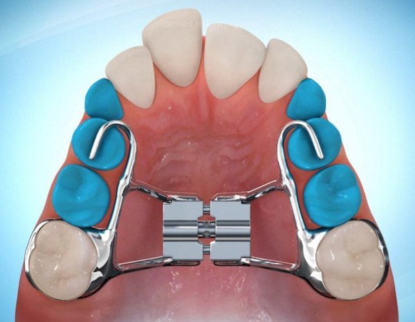 Disjoncteur en orthodontie