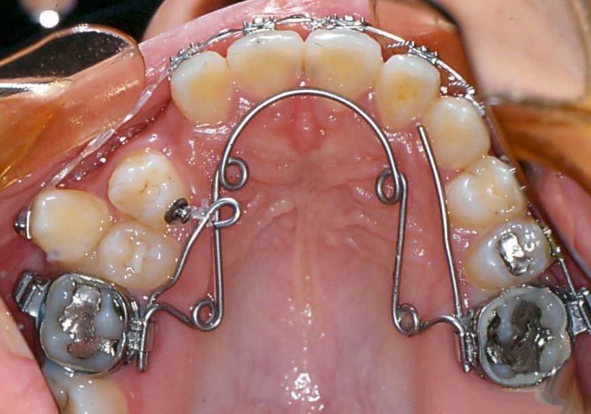 biomecanique de déplacement dentaire chez l'adulte 01