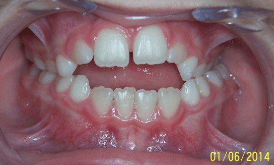 17-dents
