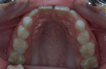 18-dents