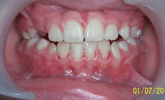 19-dents