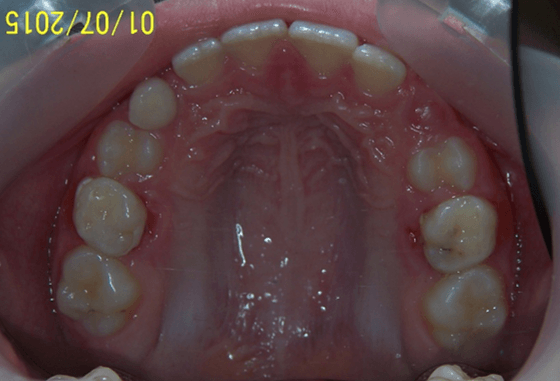 20-dents