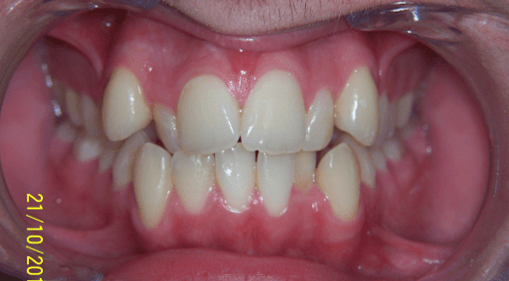 28-dents