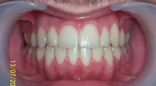 29-dents