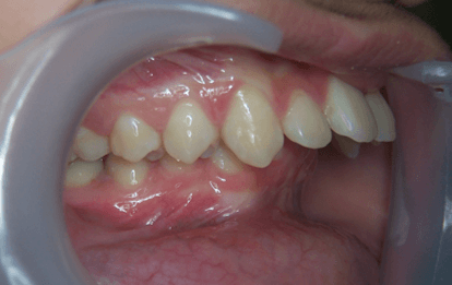 31-dents