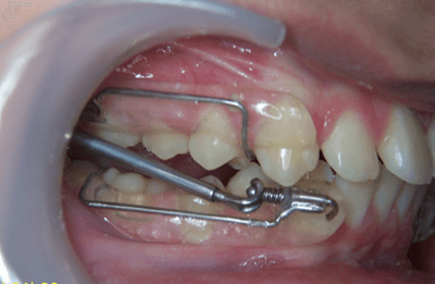 32-dents