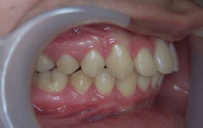 33-dents