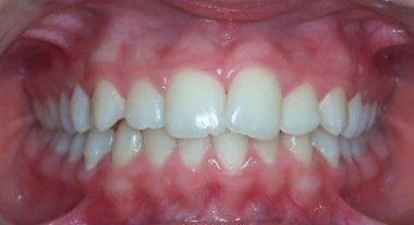 61-dents