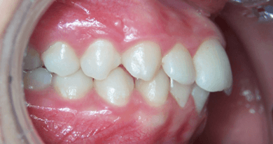 62-dents