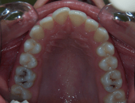 63-dents