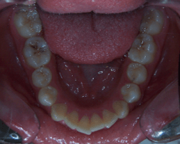 64-dents