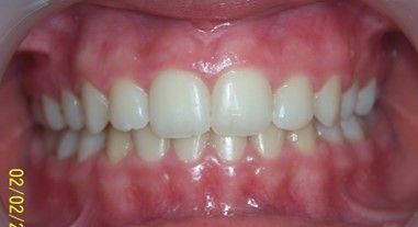 66-dents