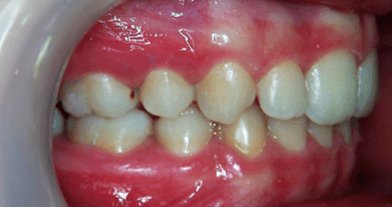 67-dents