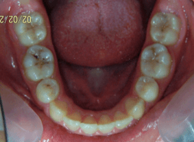 69-dents