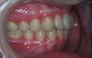 74-dents
