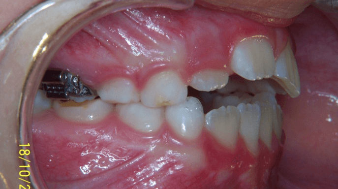 81-dents-D