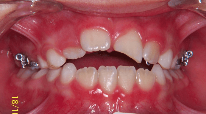82-dents-C