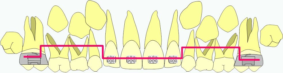 Moule par impression 3D - CISCO - Formation en orthodontie en