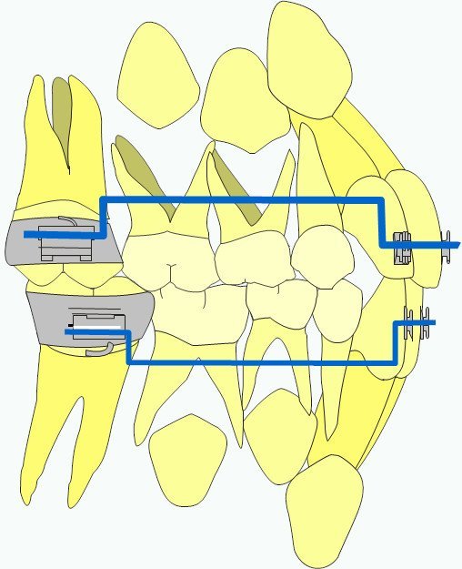 Moule par impression 3D - CISCO - Formation en orthodontie en