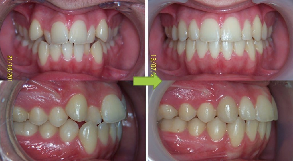 Moule par impression 3D - CISCO - Formation en orthodontie en