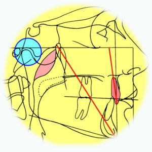 Moule par impression 3D - CISCO - Formation en orthodontie en