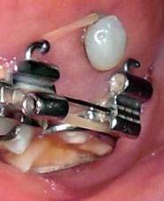L'intérêt des Mini-vis en orthodontie par le Docteur Guillaume JOSEPH -  CISCO - Formation en orthodontie en France, formation orthodontie à Paris,  formation d'orthodontiste