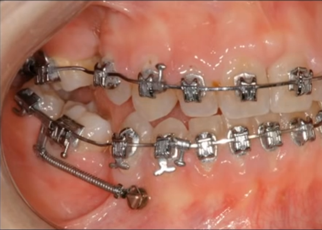 Minivis d'ancrage orthodontique DX-OMIA System