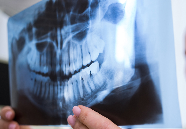 La Téléradiographie de Face : Un Outil Incontournable pour l'Analyse Orthodontique