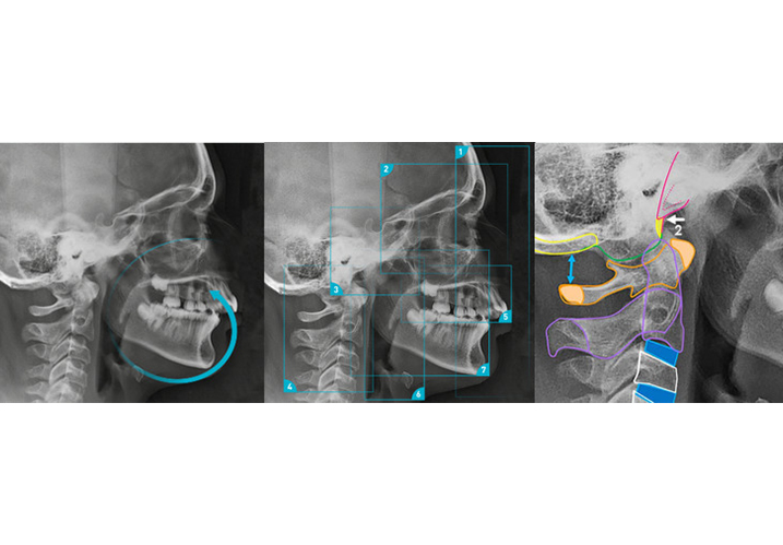 Téléradiographie Céphalométrique : Un Outil Clé en Orthodontie
