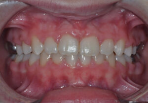 Extractions en Orthodontie