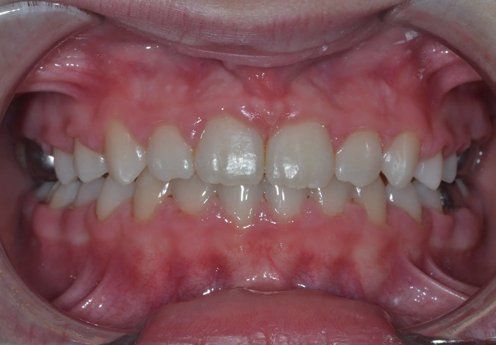 Extractions en Orthodontie
